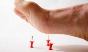 Нейропатия и полинейропатия нижних конечностей при диабете