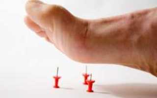 Нейропатия и полинейропатия нижних конечностей при диабете