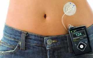 Инсулиновая помпа: отзывы диабетиков про аппарат