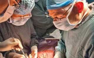 Последствия, прогноз здоровья и жизни после операции на поджелудочной железе