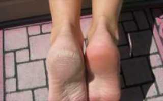 Трескается кожа на пятке при диабете причины и терапия