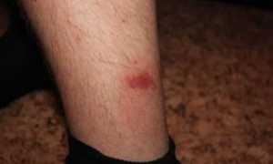 Красные пятна на ногах при сахарном диабете: подробнее об изменениях кожи