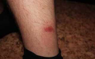 Красные пятна на ногах при сахарном диабете: подробнее об изменениях кожи