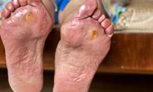 Диабетическая стопа – опасное осложнение диабета