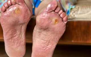 Диабетическая стопа – опасное осложнение диабета