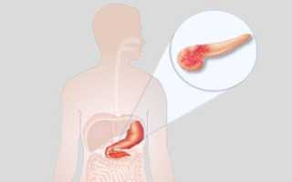 Значение диффузных изменений паренхимы поджелудочной железы