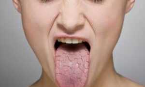 Сухость губ и рта при сахарном диабете