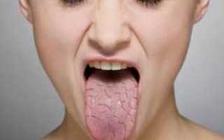 Сухость губ и рта при сахарном диабете