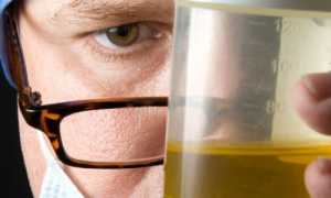 Результаты исследования диастазы мочи у взрослых при развитии панкреатита