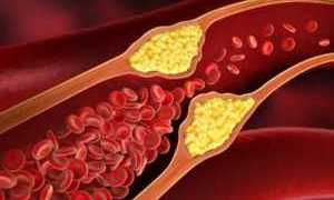 Поражение сосудов при сахарном диабете 2 типа