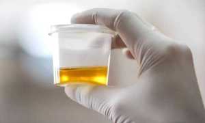 Анализ мочи по Нечипоренко