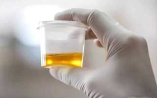 Анализ мочи по Нечипоренко