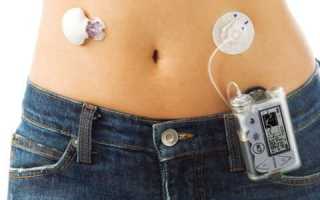 Инсулиновая помпа для диабетиков. Разновидности, назначение, принцип работы и другие особенности.