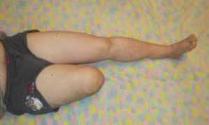 Ампутация ноги при сахарном диабете