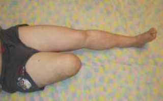 Ампутация ноги при сахарном диабете