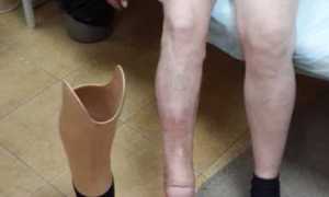 Ампутация: сахарный диабет приводит к тяжелым последствиям