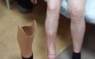 Ампутация: сахарный диабет приводит к тяжелым последствиям