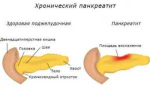 Таблетки от поджелудочной железы