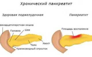 Таблетки от поджелудочной железы
