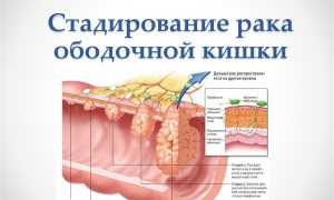 Рак ободочной кишки: основные факты