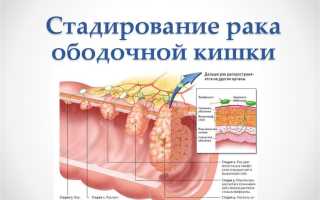 Рак ободочной кишки: основные факты