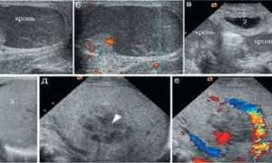 Повышенная эхогенность поджелудочной железы