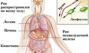 Рак поджелудочной железы 4 стадии