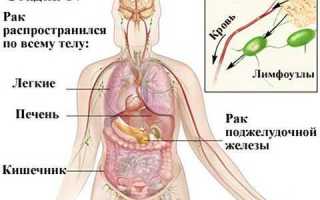 Рак поджелудочной железы 4 стадии