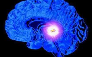 Симптомы и виды кисты головного мозга, способы диагностирования и лечения