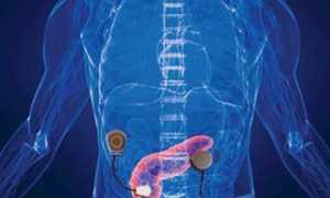 Что такое искусственная поджелудочная железа?