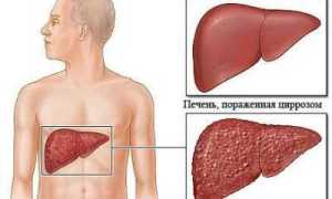 Билиарный цирроз печени