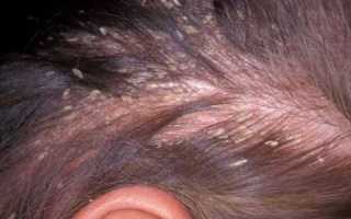 Диабет и заболевания кожи