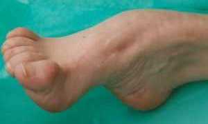 Стопа Шарко при диабете фото сустава, лечение