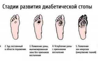 Синдром диабетической стопы