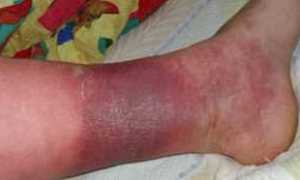 Гангрена (некроз) ног при диабете симптомы и лечение