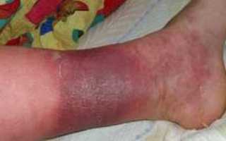 Гангрена (некроз) ног при диабете симптомы и лечение