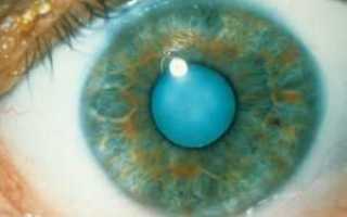 Катаракта и сахарный диабет делать ли операцию