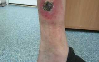 Трофические язвы при сахарном диабете