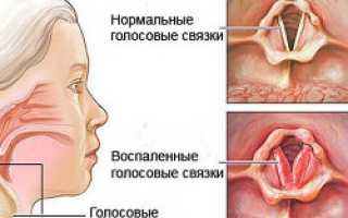Причины, симптомы и лечение ларингита у детей разного возраста