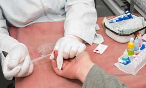 Инсулиновая резистентность тест, лечение