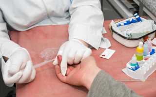 Инсулиновая резистентность тест, лечение