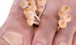 Почему грибковые поражения часто проявляются при сахарном диабете и как их лечить?