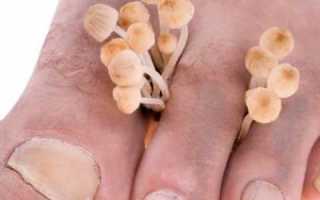 Почему грибковые поражения часто проявляются при сахарном диабете и как их лечить?