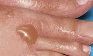 Кожный зуд при сахарном диабете