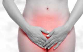 Молочница при СД 1 и 2 типа у женщин