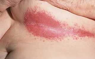 Фото высыпания на коже при диабете и средства для его лечения