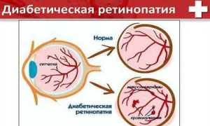 Ретинопатия при сахарном диабете: что это такое и как лечить медикаментозно