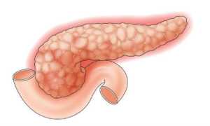 Хронический билиарнозависимый панкреатит