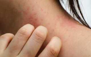 Заболевания и реакции кожи при сахарном диабете