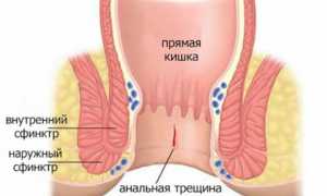 Лечение анальной трещины